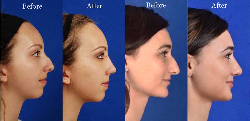 What are the major health benefits of rhinoplasty surgery?