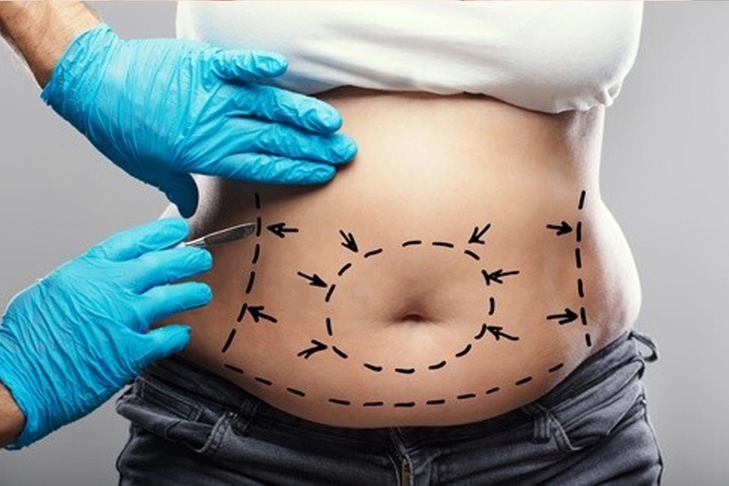 Abdominoplasty Procedure in India